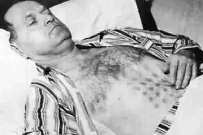 NLO susret u Kanadi 1967. godine: Teške opekotine i istopljeni vrhovi prstiju