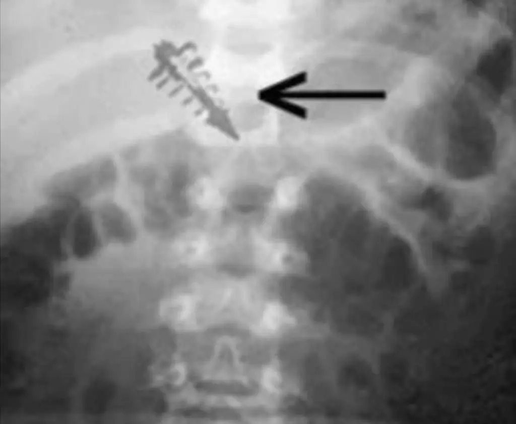 Vanzemaljski implantati: Ultimativni dokaz vanzemaljskih otmica? 9 implants